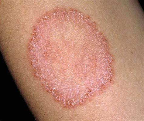 ringworm in humans