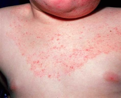ringworm in infant