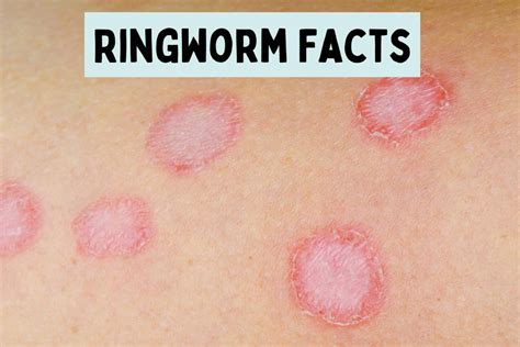 What You Need to Know: Ringworm is Caused by These Surprising Factors