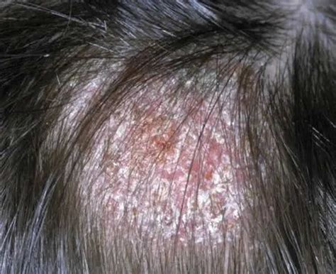 Understanding and Managing Ringworm of the Scalp: Causes, Symptoms, and Effective Treatments