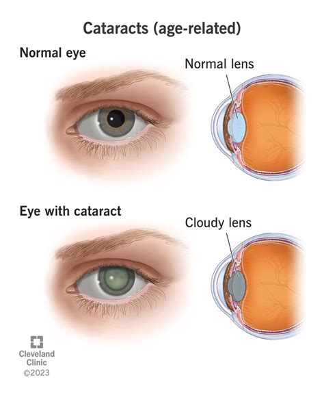 ripe cataracts definition