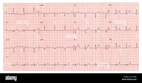 ritmo sinusal normal electrocardiograma