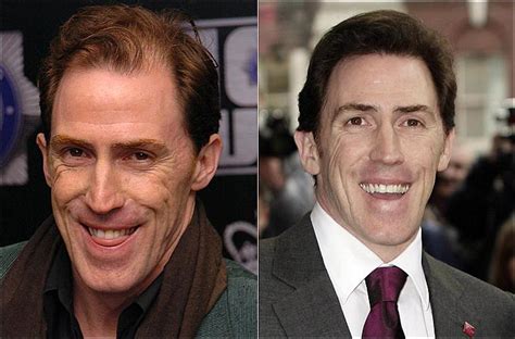 rob brydon hair transplant