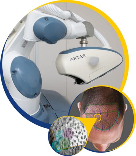 ARTAS 9x Major Upgrade to Robotic Hair Transplant System