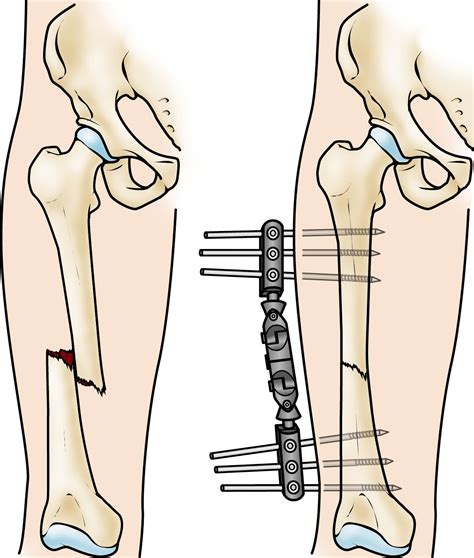 rod vs plate for femur fracture