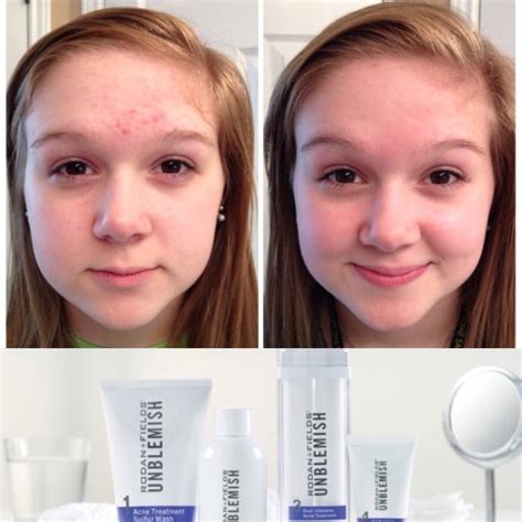 rodan and fields acne skin care