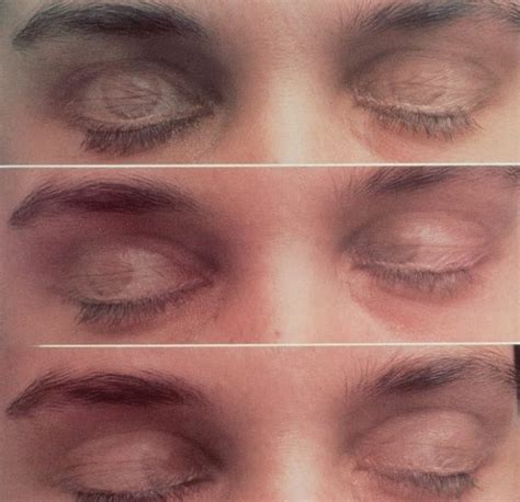 Rolling Eye Movement Sleep