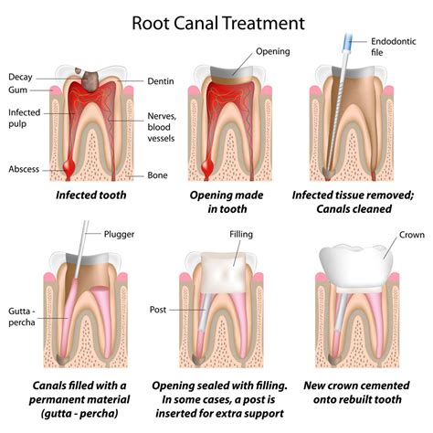 Root Canal Crown Procedure