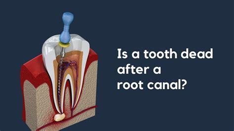 Root Canal Dead Tooth