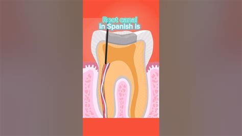 root canal in spanish dental