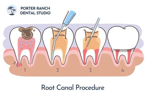 Root Canal Procedure Code Canada