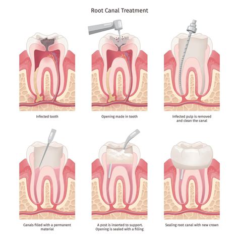 Root Canal Procedure Involved