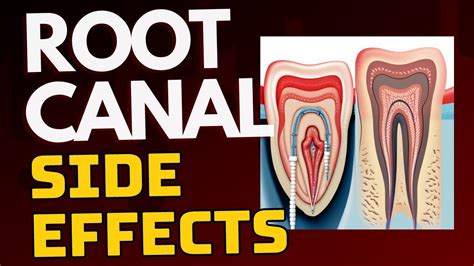 Root Canal Procedure Side Effects