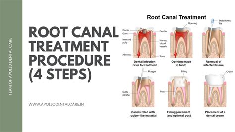 Root Canal Therapy Procedure