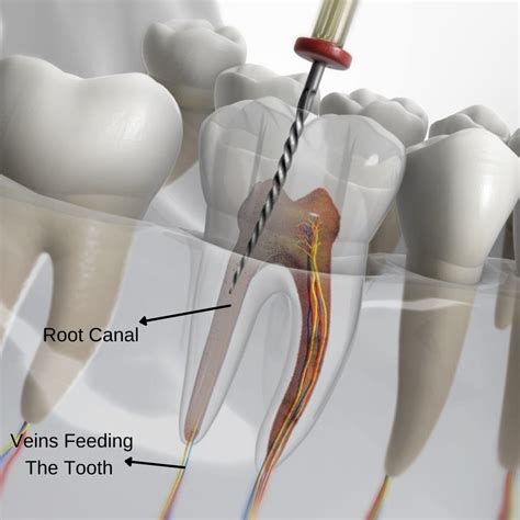 Root Canal With Irrigation
