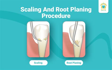 Root Planing And Scaling Procedure