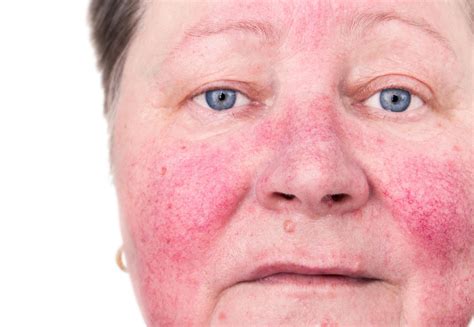 Manfaat Amoksisilin untuk Rosacea