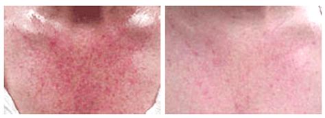 Understanding Rosacea on Chest: Causes, Symptoms, and Effective Treatment Options