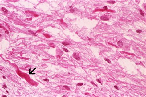 rosenthal fibers brain tumor
