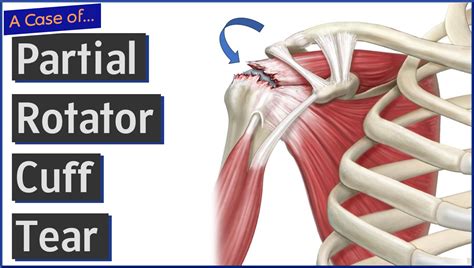 Rotator Cuff Surgery Partial Tear