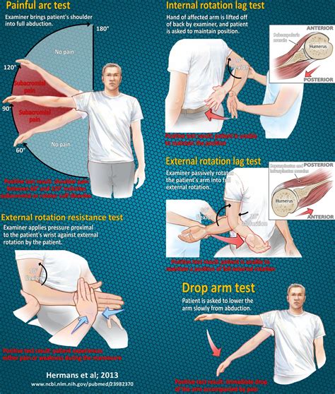 Rotator Cuff Tear Examination