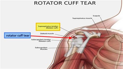 Rotator Cuff Tear Settlement