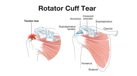 Rotator Cuff Tear Uk