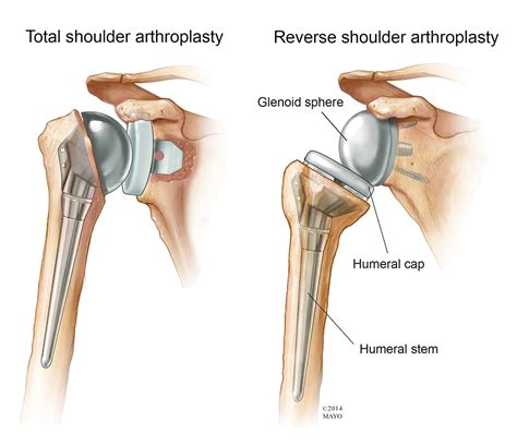 Rotator Cuff Vs Shoulder Replacement