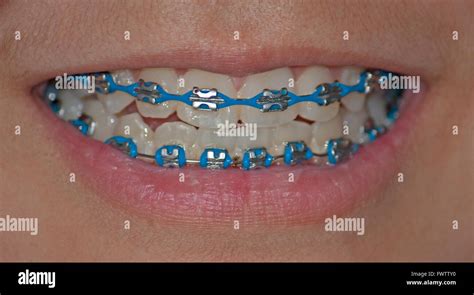 Royal Blue Braces