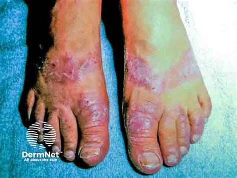 Rubber Slipper Allergy