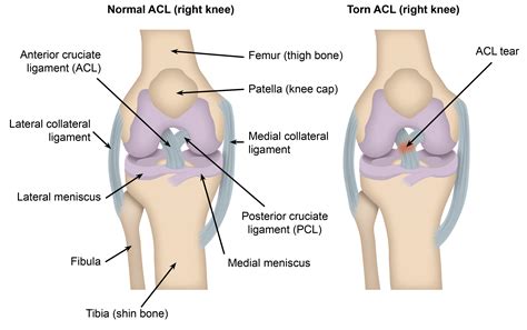 Runners Knee Vs Acl