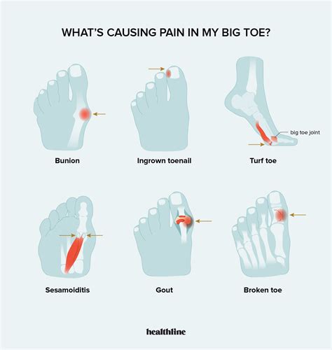 Running Big Toe Joint Pain