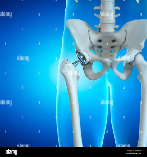 Running Causing Hip Replacement
