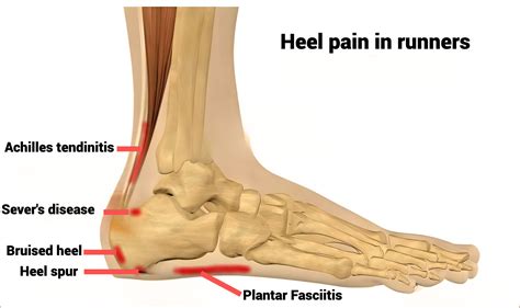 Running Heel Soreness