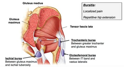 Running Injury Upper Glute