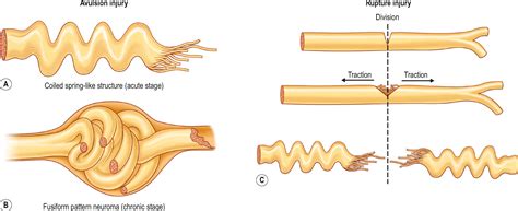 Rupture Vs Avulsion