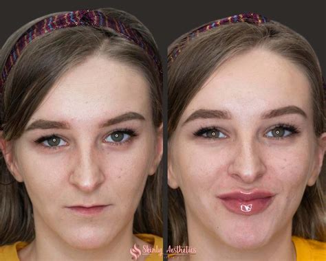 Russian Lips Vs Juvederm