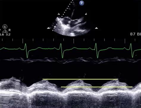 Rv Dysfunction In Echo
