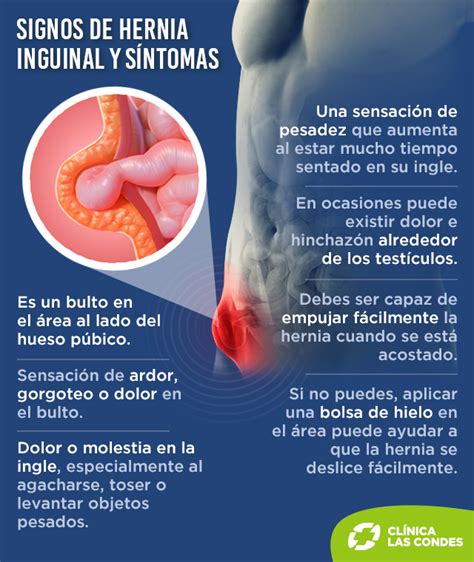 síntomas de una hernia inguinal