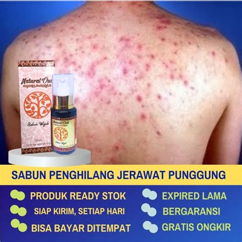 Rekomendasi Merk Sabun Muka Penghilang Jerawat dan Bekasnya