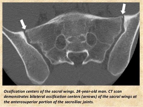 sacral ossification centers radiology