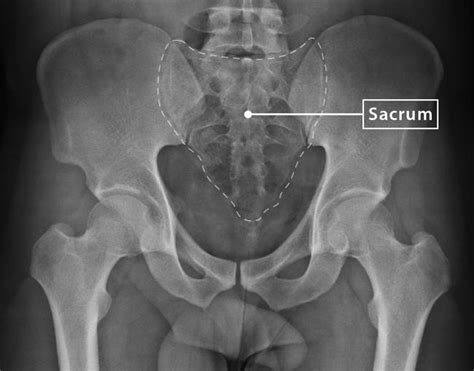 Sacrum X Ray Angle