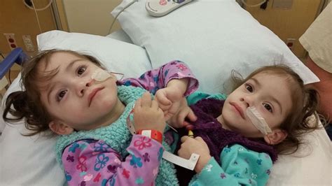 sad news about conjoined twins