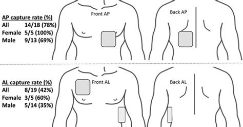 safety margin for transcutaneous pacemaker