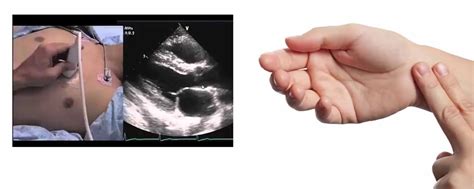 safety margin transcutaneous pacing