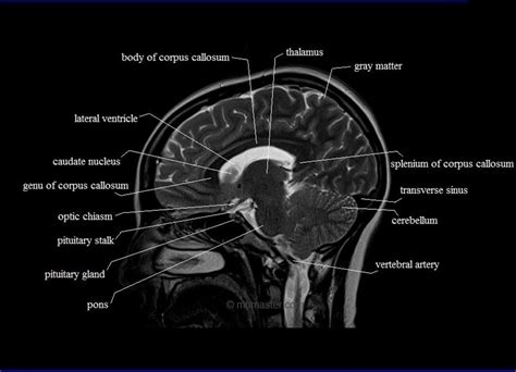 Sagittal Brain Mri Labeled