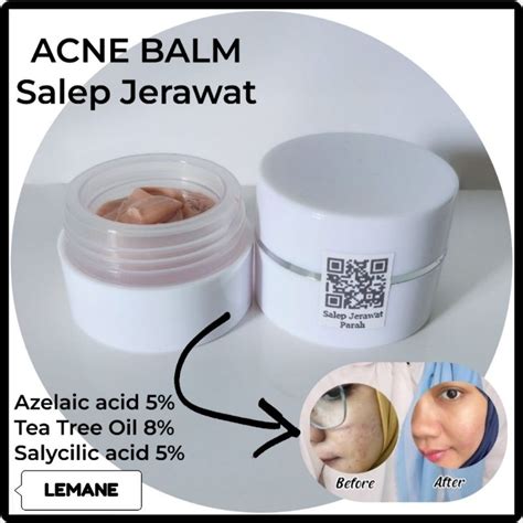  Rahasia Kulit Mulus Tanpa Jerawat: Salep Jerawat Pasir Ampuh!