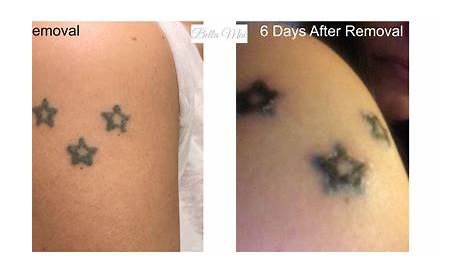 Saline Tattoo Removal Before And After Miami Roni Tolliver