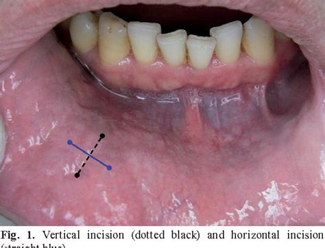 salivary gland biopsy by incision cpt code