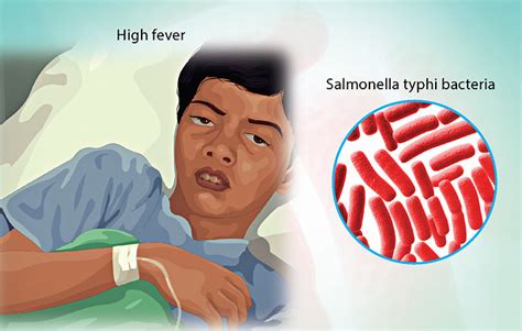 salmonella typhi disease